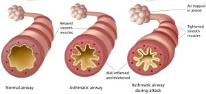 asthmatic airway