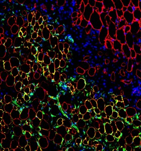 Fat cells from mesenchymal stem cell transplant